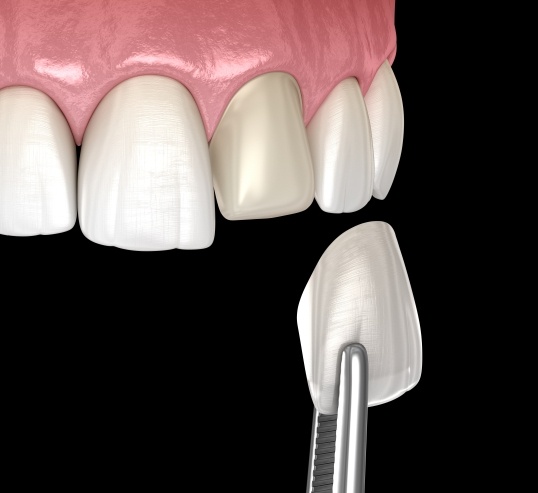 Image of tooth veneer