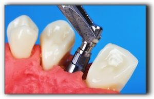 Dental Implant Dental implant procedure